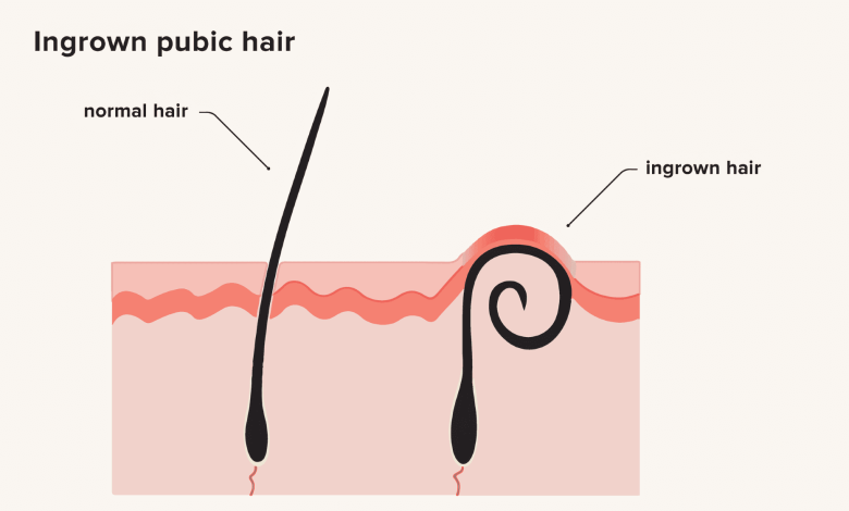 How To Treat Prevent Ingrown Hairs