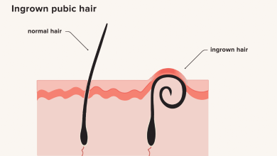 How To Treat Prevent Ingrown Hairs